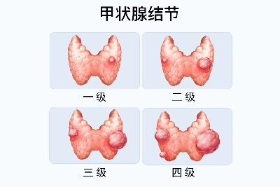 甲状腺结节