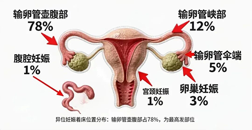 宫外孕术后再次备孕,输卵管造影是必做项目吗?