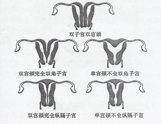 先天子宫畸形国外试管婴儿成功率多大？