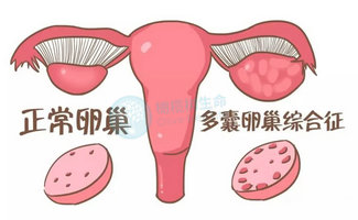 多囊卵巢综合征试管婴儿成功好孕分享