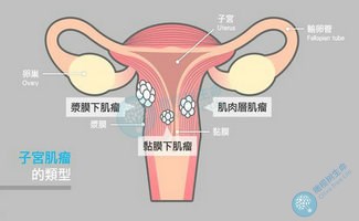 有子宫肌瘤还能进行试管婴儿备孕吗？