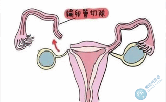 双侧输卵管切除做试管婴儿多少钱