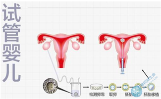 三代“试管婴儿”有什么不同