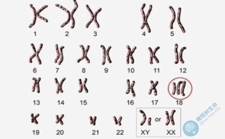 橄榄树生命：染色体异常之18-三体综合征！