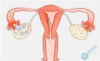 患有多囊卵巢做试管婴儿，可以取到健康卵子吗？