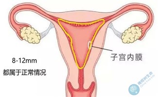 子宫内膜厚度多少适合？移植前内膜不达标如何应对