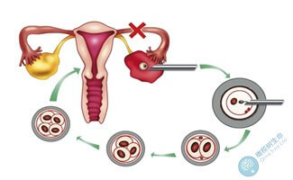 试管婴儿流程分几步？揭秘每一个步骤