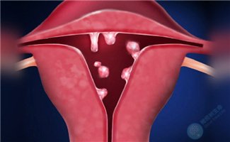 去泰国做试管需要先处理子宫内膜息肉吗？