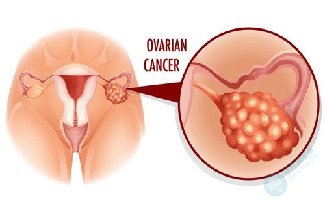 什么的卵巢多囊样改变，借助试管技术能否成功生育呢？