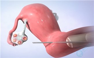 做试管婴儿，取卵和移植的时候要不要素颜？