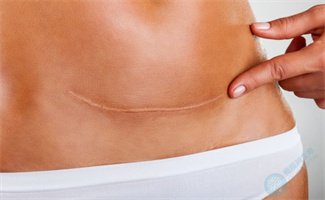 疤痕子宫备孕二孩？这条“安全线”要牢记